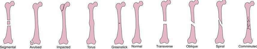 kinésithérapie les différents type de fractures